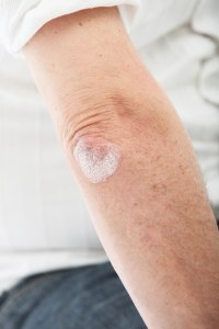 Is the sun good for psoriasis?