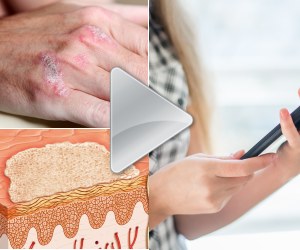 Psoriasis Videos